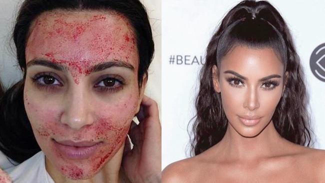 Vampire facial: ‘I tried the gory anti-ageing treatment, and the results surprised me'