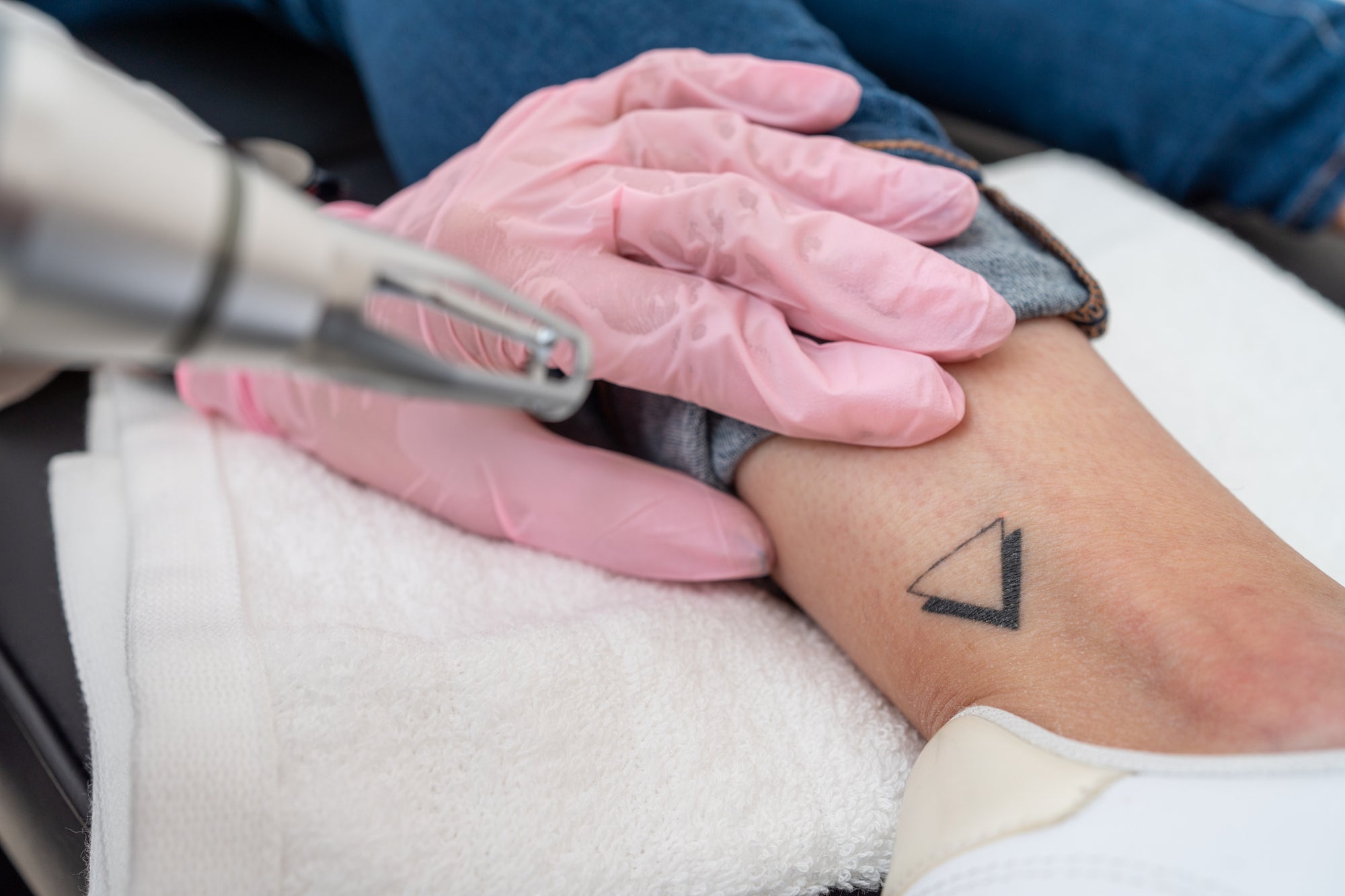 Tattoo Removal Packages